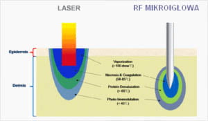 laser do rf mikroigłowa - porównanie