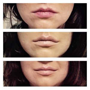 efekty zabiegu powiększania i modelowania ust - zdjęcie 32