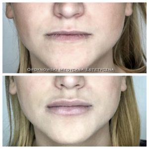 efekty zabiegu powiększania i modelowania ust - zdjęcie 15