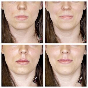 efekty zabiegu powiększania i modelowania ust - zdjęcie 35