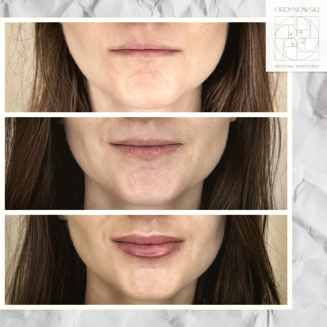 Powiększanie ust – co warto wiedzieć?