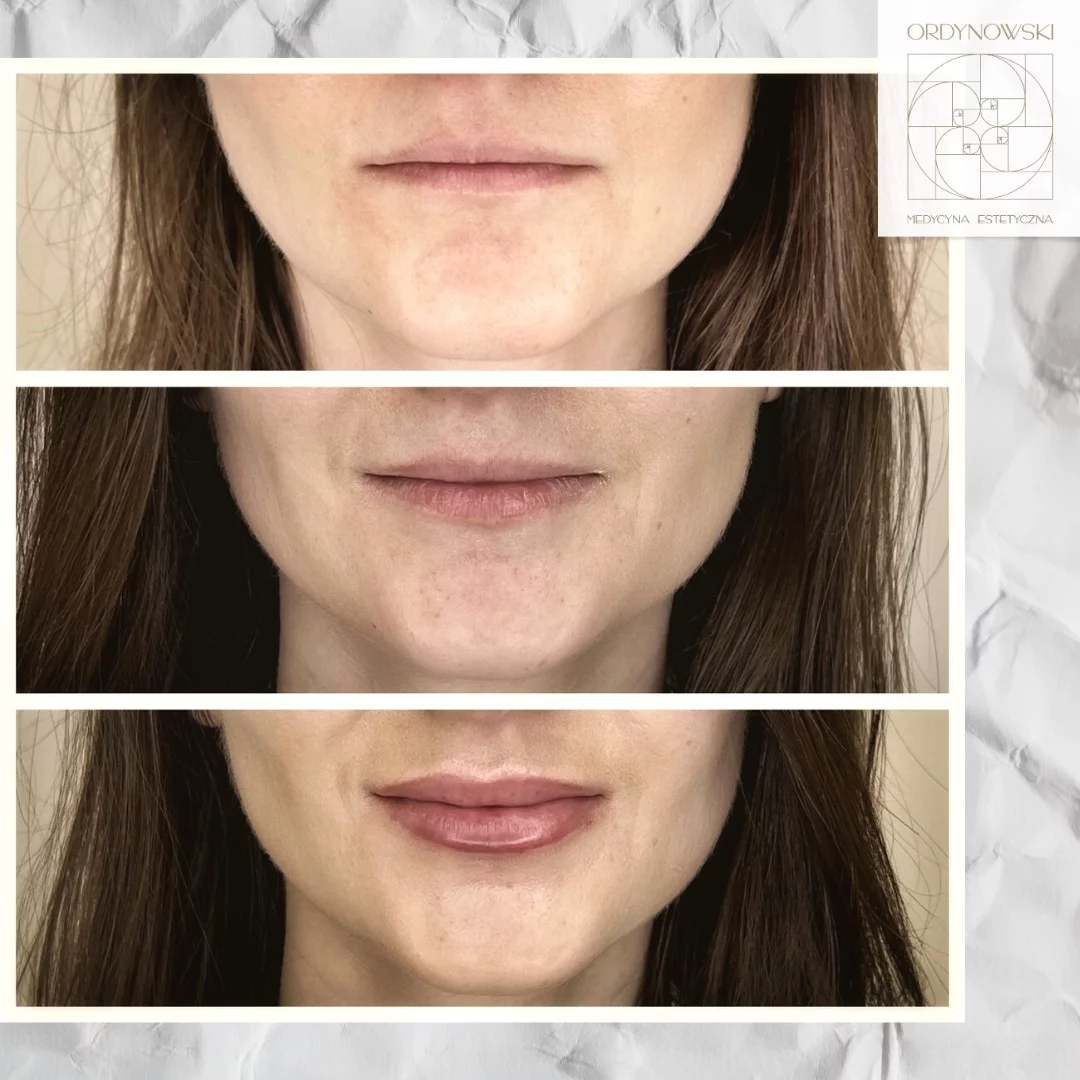 Powiększanie ust – co warto wiedzieć?