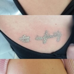 laserowe usuwanie tatuażu zdjęcie 04